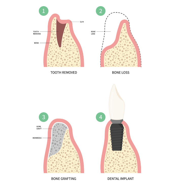 Bone Graft Danville | Dental Implant Surgeon